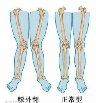 是股骨相对胫骨过度内旋,视觉上膝盖髌骨向内,而腘窝向外 q2