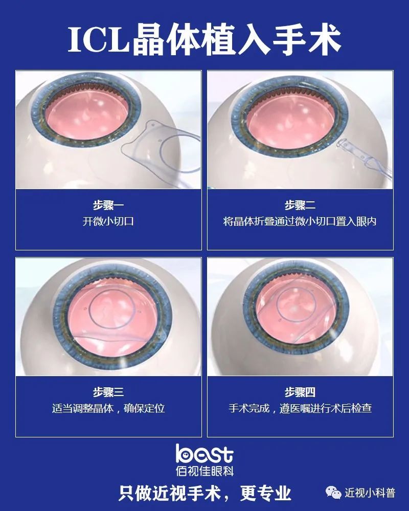 Ic晶体植入近视手术费用 腾讯新闻