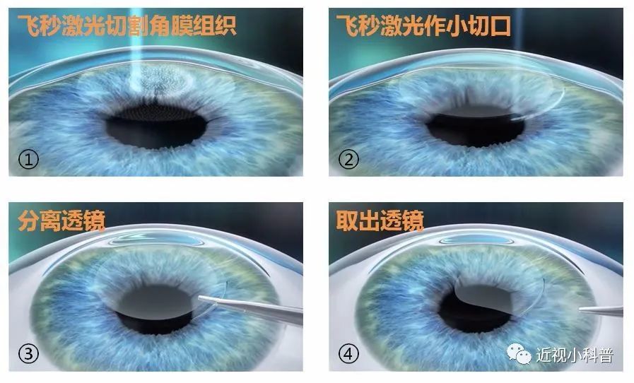 科普 全飞秒 半飞秒做近视手术哪种更好 腾讯新闻