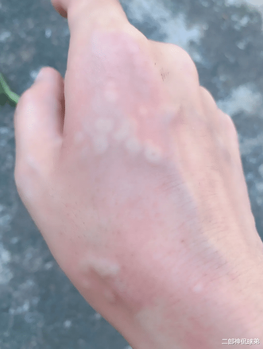 "被这个怪物咬了这么多口,还有救吗?"哈哈哈……问题不大