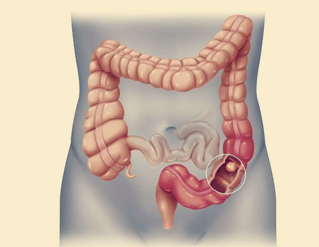 大肠结肠傻傻分不清科普一下你不知道的大肠癌3类人要警惕