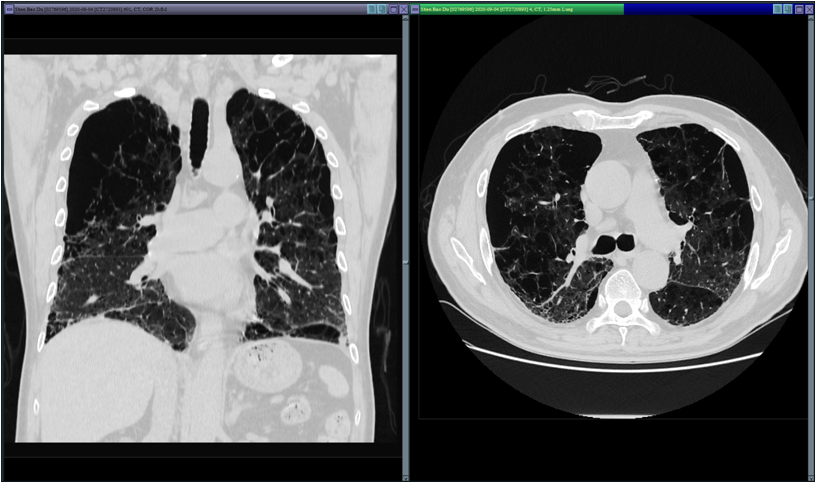 手术|再创生命奇迹！一天三台高难度肺移植手术，刷新浙江肺移植纪录
