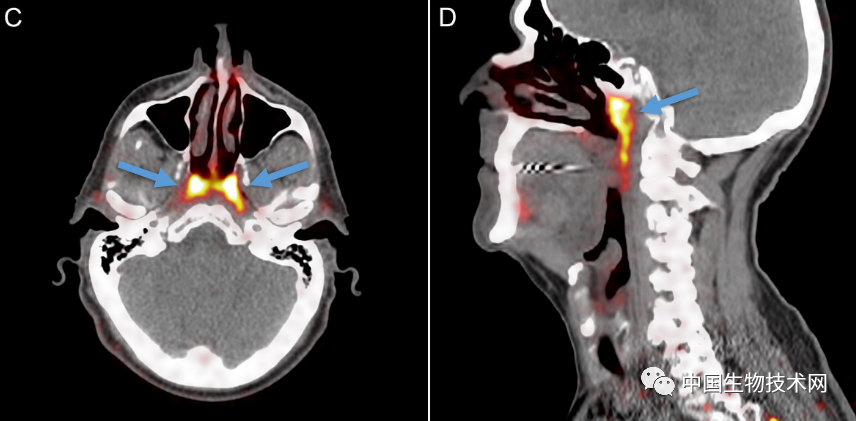 鼻咽|意外发现！鼻咽中一个被忽略几个世纪的“神秘组织”