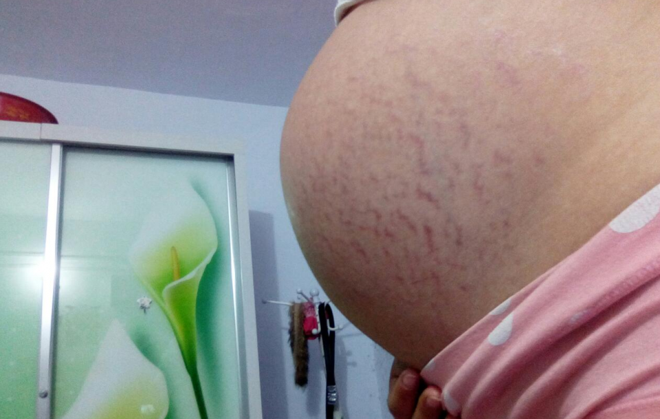 不想产后肚子变"西瓜皮",预防妊娠纹,不同阶段方法不一样