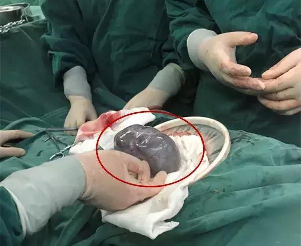 产科医生大半夜为孕妇做急诊手术,剖开肚子拿出的居然不是孩子