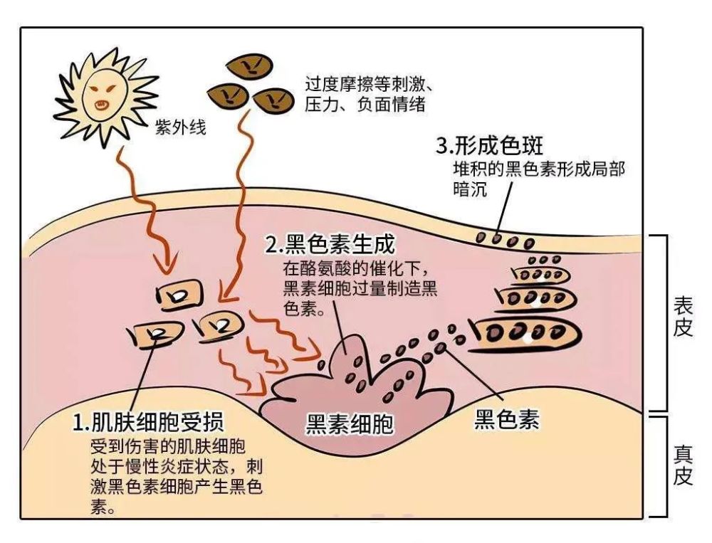 白癜風誘因多,只有這個才是真正的黑色素殺手!