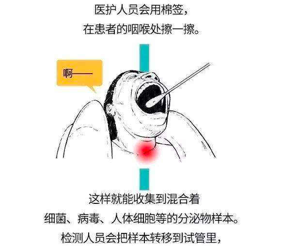 咽反射检查方法图片