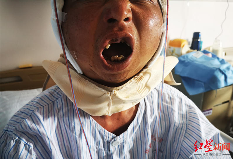 崔先生手术后终于可以张嘴最后,医生提醒,颞下颌关节强直大多数是外伤