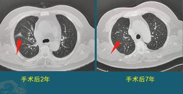 肥厚 胸膜