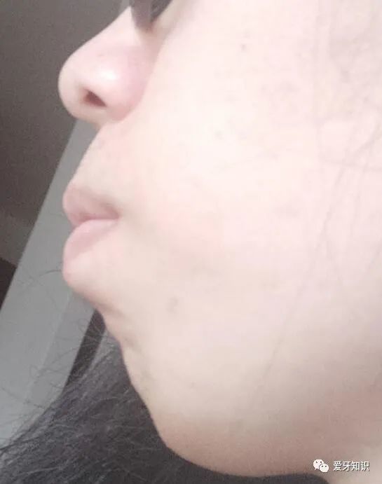 不是谣传 牙齿矫正真的可以对脸型 特别是侧脸 腾讯新闻