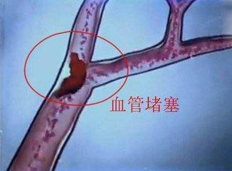 血管堵塞脚先知 脚部出现这种信号 暗示血管可能已经堵塞 血管堵塞 血管 动脉 蔬菜