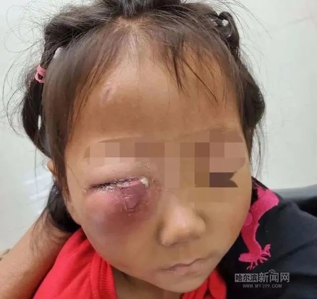 病根|龋齿|icu|牙源性蜂窝组织炎