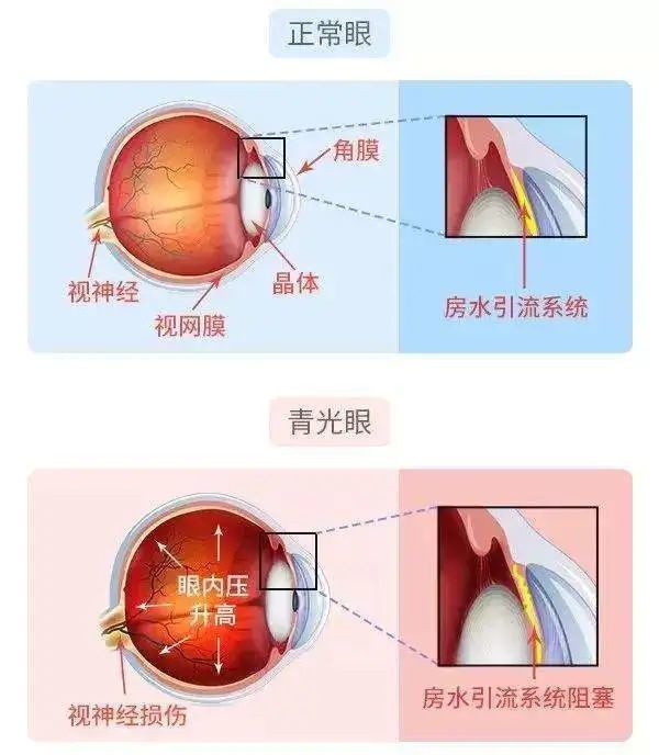 【警惕】眼压太高,当心青光眼!