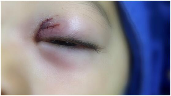 女童不慎撞伤致泪小管断裂,求医之路一波三折