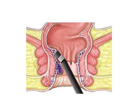 痔瘡肉球怎麼去除用啥藥好農村有一寶可改善痔瘡可惜很少人知道