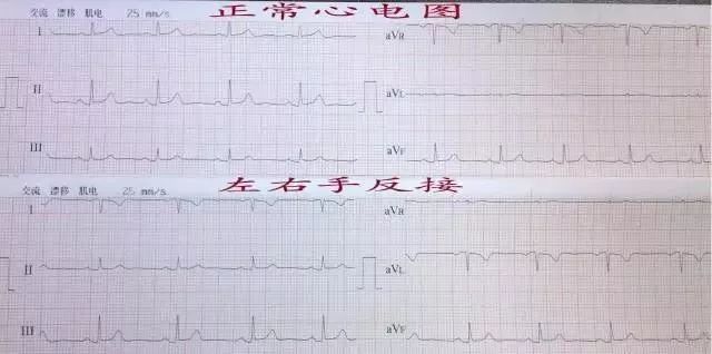 心電圖中干擾和偽差的鑑別診斷