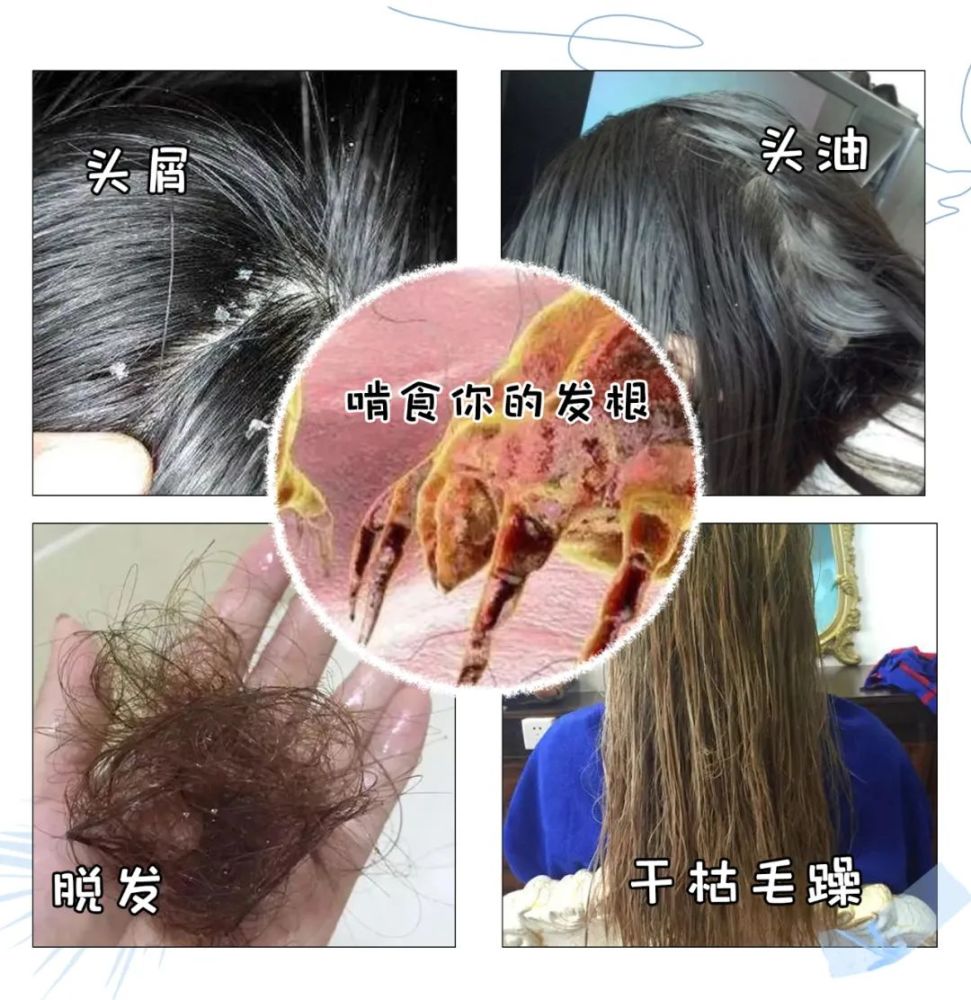 头油头痒还脱发求你快换个洗发水吧小心头螨越洗越多