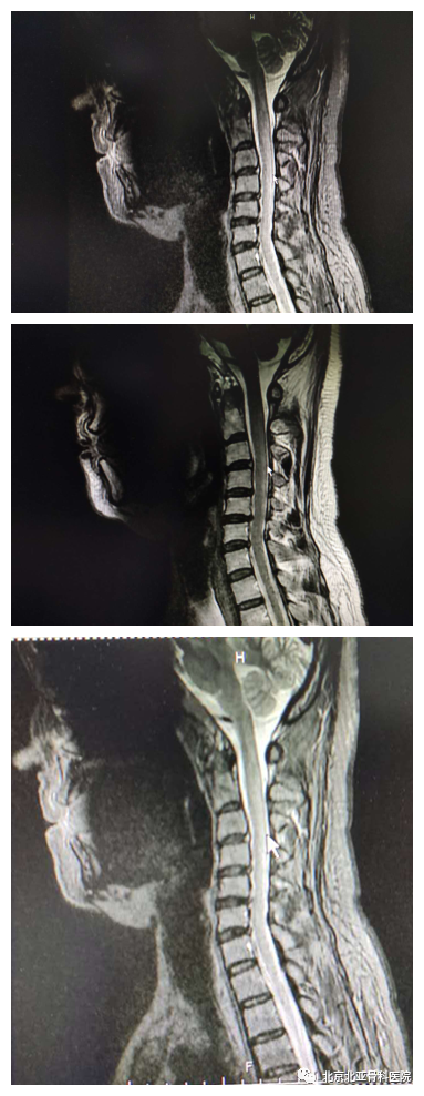 亚急性脊髓联合变性致四肢麻木,神经内科精准诊治,赢得患者点赞!