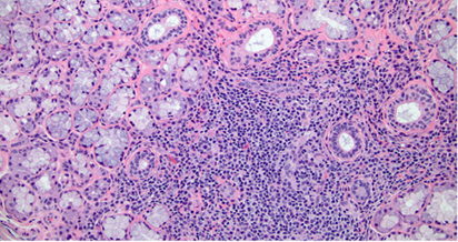 患者的免疫系统靶向攻击唾液腺,使后者被巨噬细胞,肥大细胞,b细胞,t