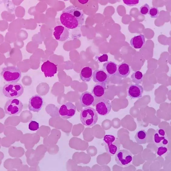 粒红比倒置(粒:红=1:1),成熟红呈拥挤排列(图2);nap染色阳性率12%