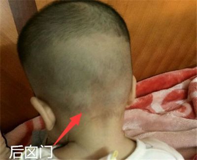 顺产分娩,经过产道挤压,新生宝宝的囟门会提早闭合吗?_腾讯新闻