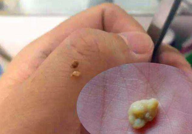 儿子被同学嫌弃嘴太臭,牙医取出的颗粒,宝妈闻了都直皱眉