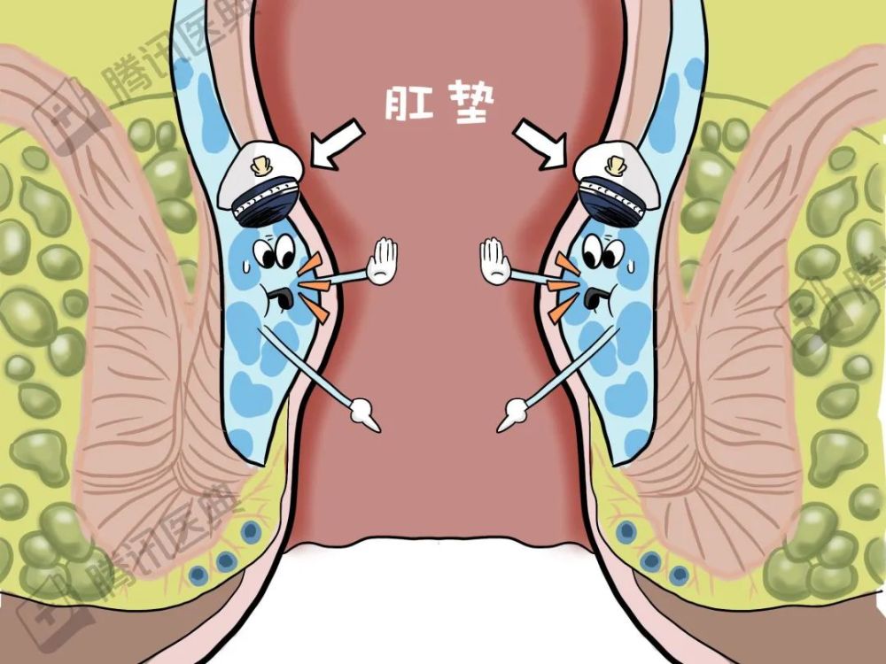 肛垫好比交警,指挥着肛门的交通简称肛垫由静脉血管,平滑肌等组成肛管