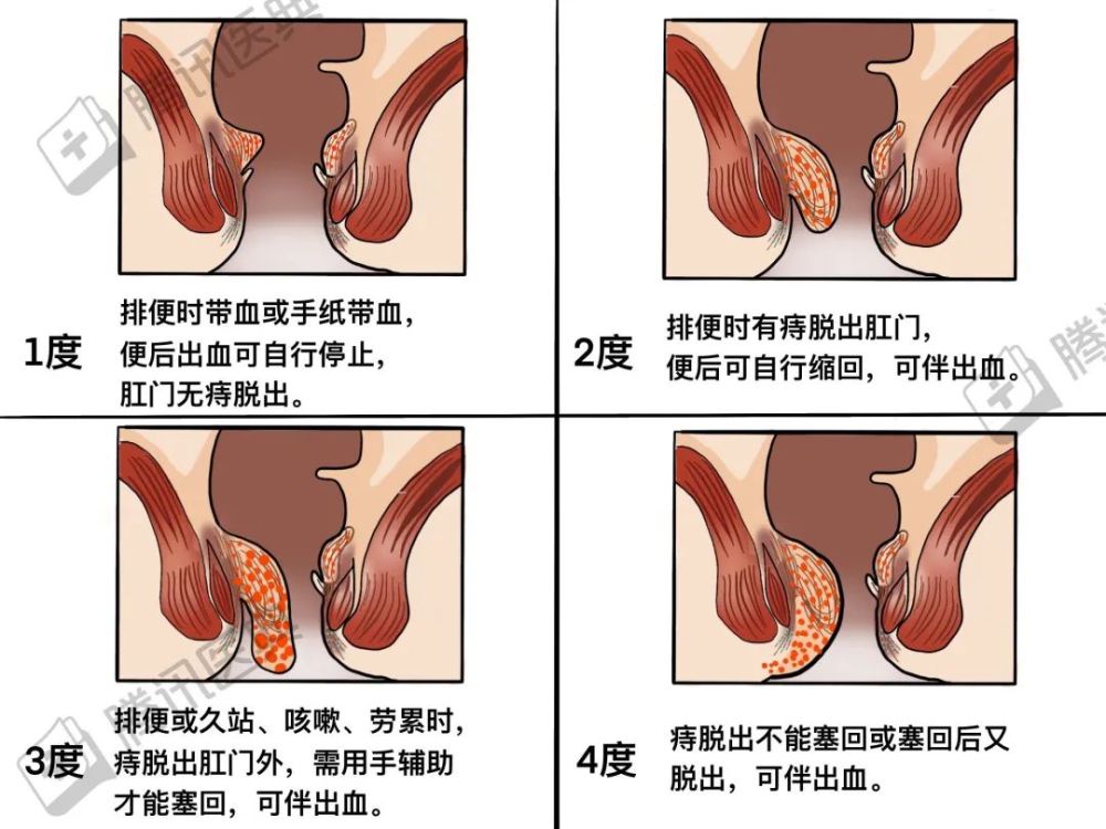 我给自己做了一个痔疮手术却差点要了自己的命