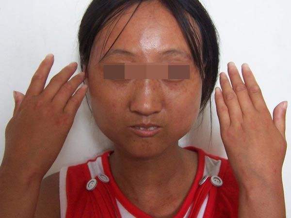 肺病|手指头忽红忽白，遇冷还会疼痛，查查风湿，有可能导致严重肺病