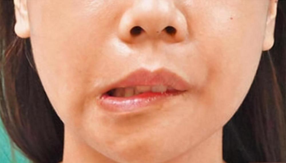 高发|27岁女网红直播突发面瘫，医生提醒：冬季中风高发期，谨记这2件事