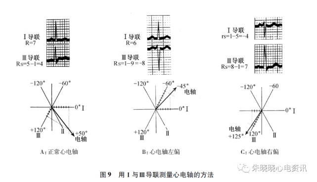 心電圖|導聯|心肌梗死|t波|心律失常