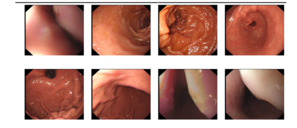 食管|罕见！59岁余姚大伯食管里长了巨大瘤，又出现魔鬼般并发症，还好……