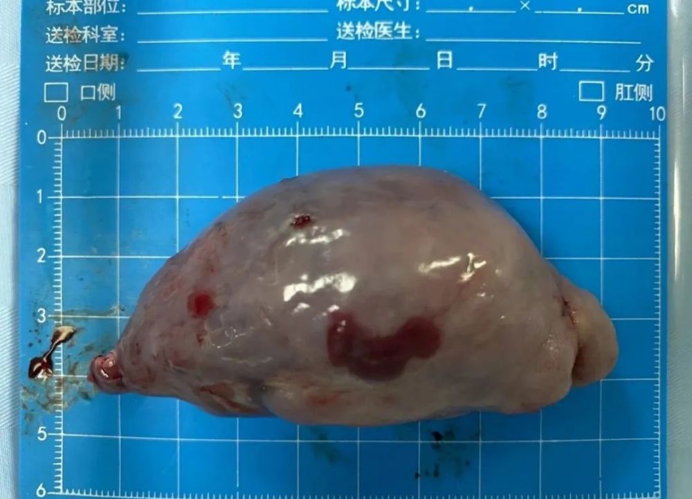 因为富有弹性,可以挤压,这个光滑的巨大的脂肪瘤最终被顺利取出.