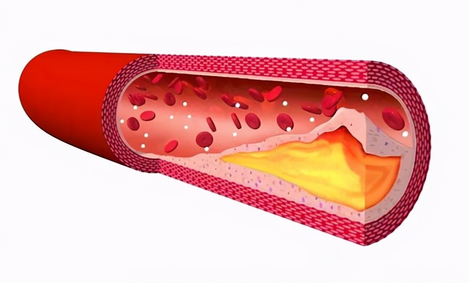 低密度脂蛋白胆固醇|低密度脂蛋白胆固醇升高，是不是血管堵塞了？医生为您讲明白