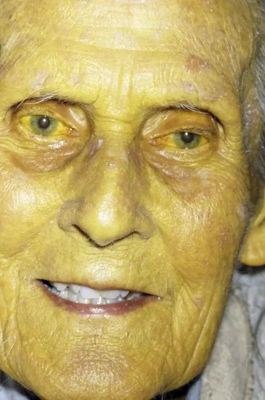 甲肝是一种怎样的传染病?为何会在1988年的上海大爆发?