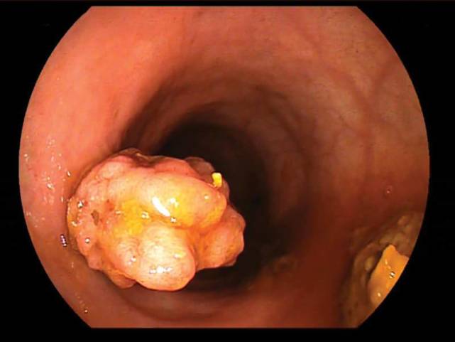 二是非腺瘤性(非肿瘤性)息肉.