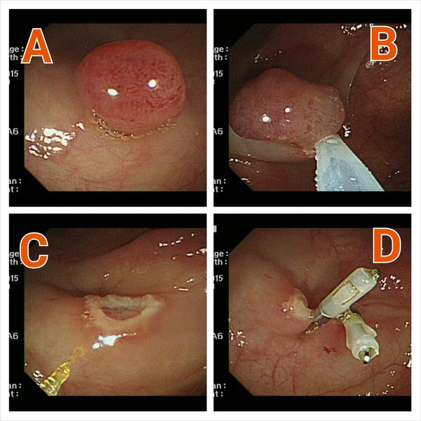 肠镜检查有息肉一定会得结肠癌吗
