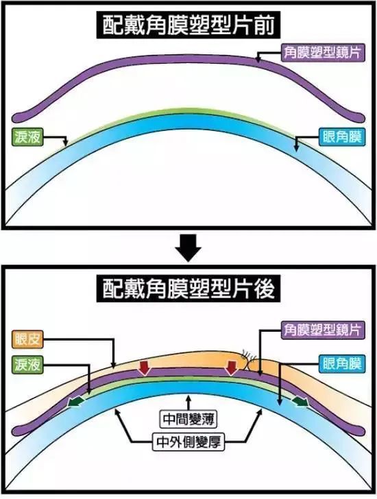 内表面是经过特殊的反几何设计,从而能对角膜进行塑形,简单来说就是让