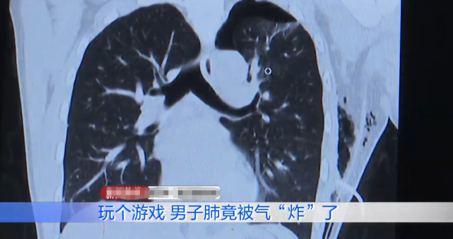 真肺都气炸了因玩游戏时队友太坑男子肺大泡炸裂