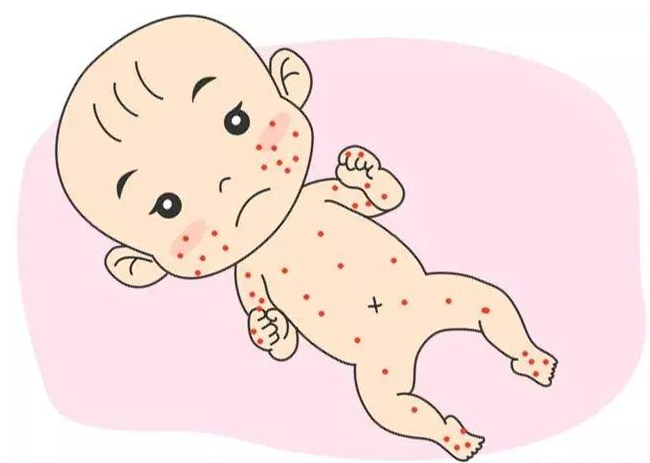 儿科医生:小儿荨麻疹并不可怕，想要好转做好这“三步”