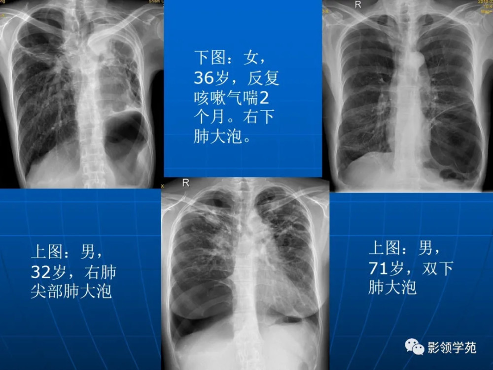 肺氣腫的影像診斷