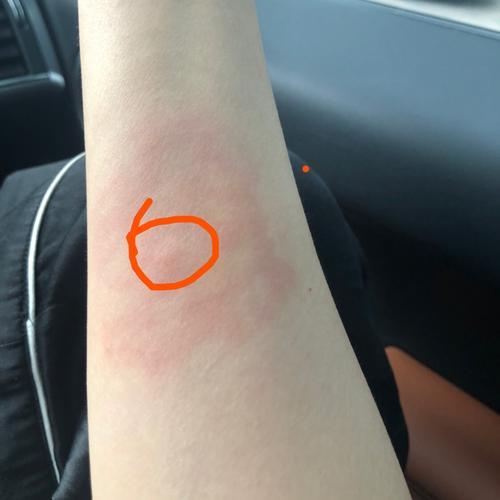 艾灸的部位出汗以及艾灸一段时间之后有红疹的解释(单桂敏)!