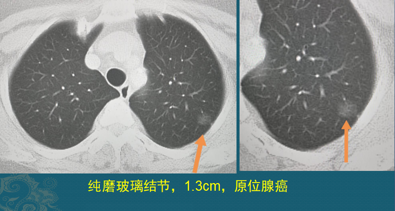 磨玻璃結節就是肺癌醫生用ct片舉4例說明前3種不要緊