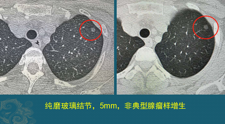 磨玻璃結節就是肺癌醫生用ct片舉4例說明前3種不要緊