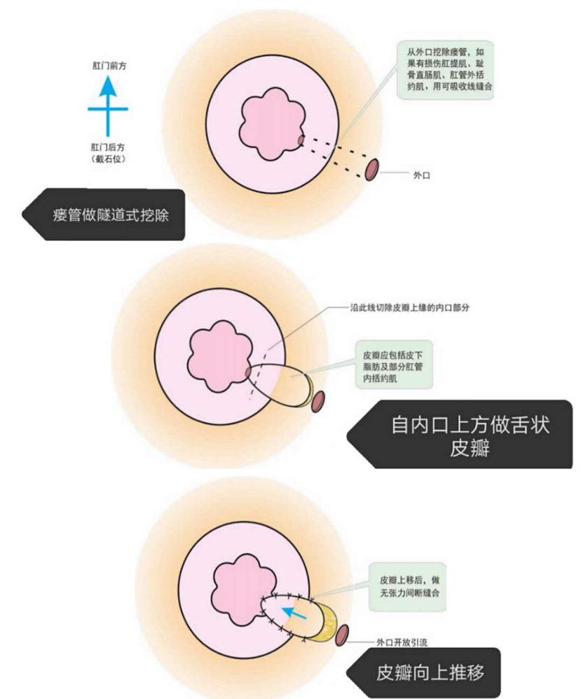 创面大 恢复慢 肛瘘手术真的有这么可怕 腾讯新闻