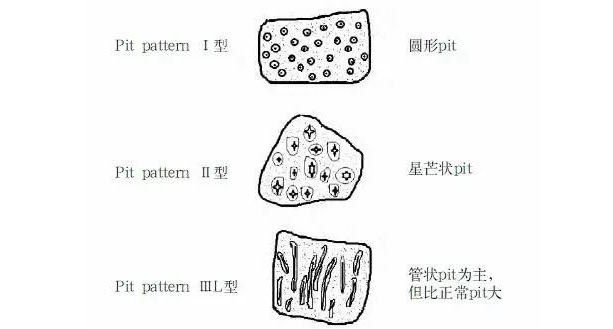 大肠癌|判断早期结直肠癌浸润深度，放大染色内镜 vs 超声内镜，谁更胜一筹？