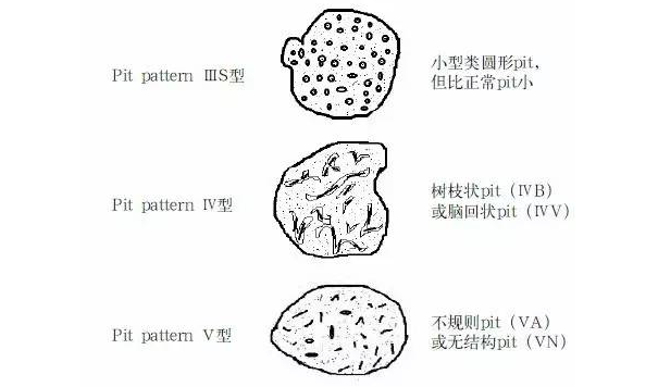 大肠癌|判断早期结直肠癌浸润深度，放大染色内镜 vs 超声内镜，谁更胜一筹？