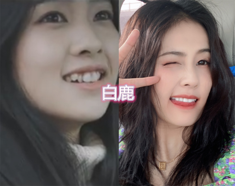 整牙前vs整牙後白鹿變化不大李佳琦十分明顯看到林心如漂亮依舊