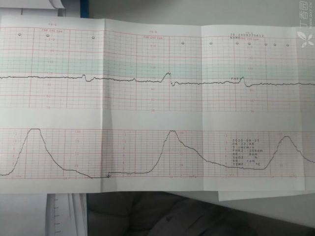 电子胎心监护微小变异剖还是顺要如何抉择