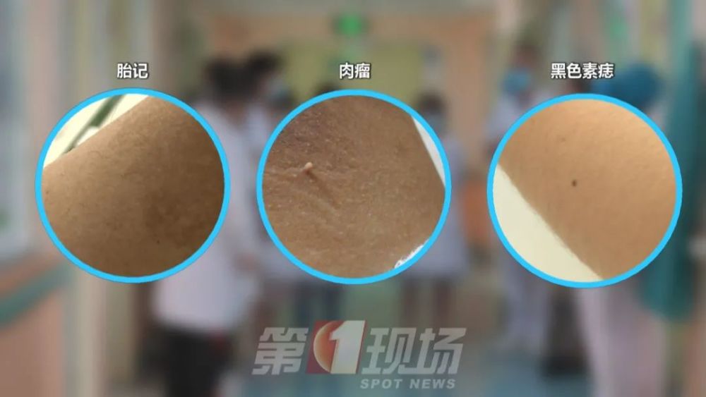 一般来说,痣分为胎记,肉瘤和黑痣,而第三种黑色素痣,就是我们常说的痣